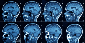Cientistas mostram que o cérebro humano está a aumentar de dimensão