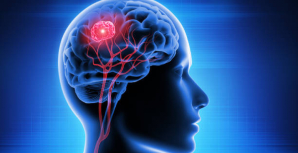 Estudo indica que imagens sintéticas melhoram diagnóstico e tratamento de tumores cerebrais malignos
